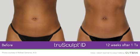 truSculpt iD fat removal treatment before and after