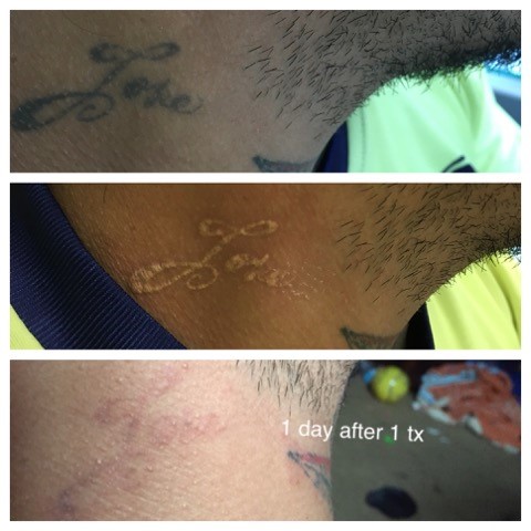 Laser Tattoo Removal Jacksonville Beach | Laser Skin Solutions