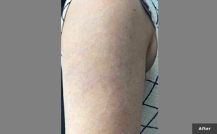 Enlighten Laser Tattoo Removal  Tareen Dermatology  Roseville Minnesota